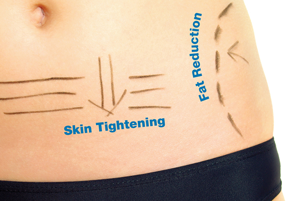 RF Fat Melting Treatment